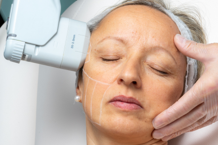 Soin du visage HIFU